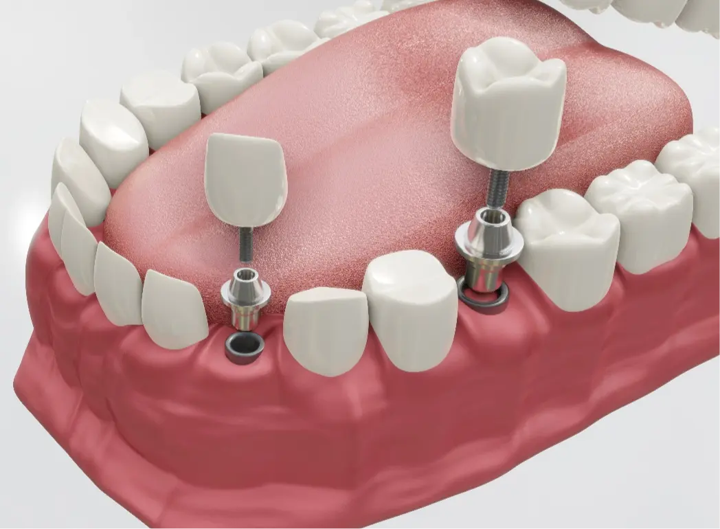 IMPLANT RESTORATIONS